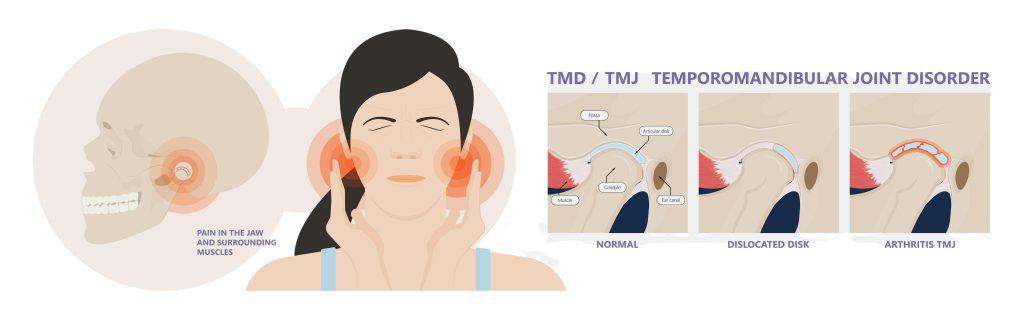Illustration of woman holding her jaw and suffering from jaw pain alongside three illustrated causes of Temporomandibular Join Disorder.  