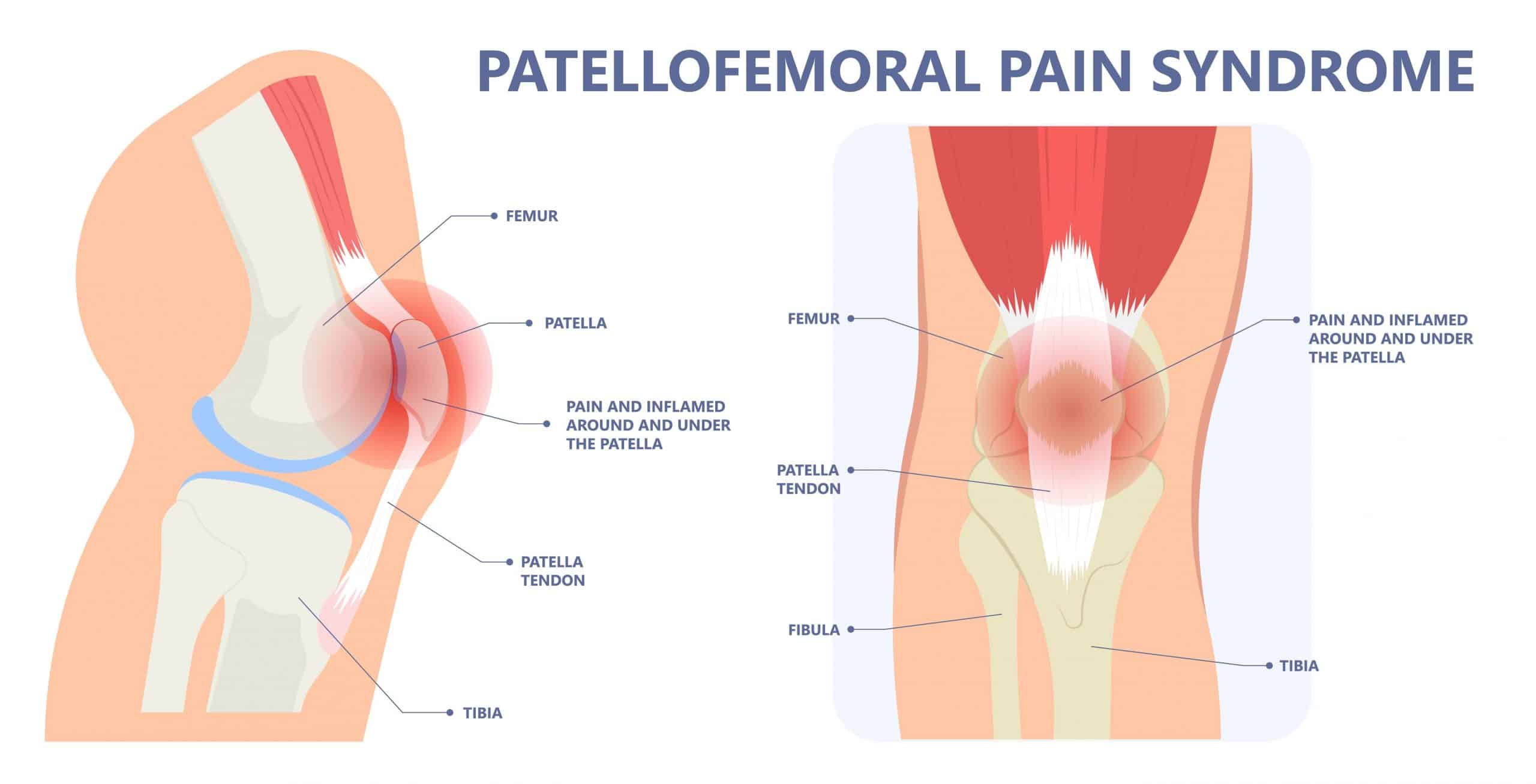Patellofemoral Dysfunction Pain Syndrome